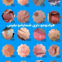 درمان اصولی و مشاوره (HPV) زگیل
