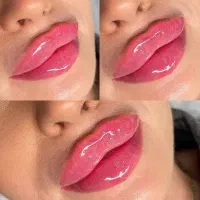 جشنواره بهاری ژل و بوتاکس