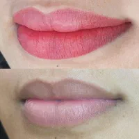 خدمات تخصصی رفع تیرگی و کبودی لب،تخفیف