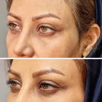 رفع تیرگی چشم دائمی