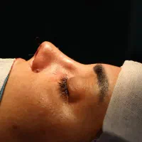 عمل بینی۲۷میلیون.لیپو.ابدو.بلفارو به صورت اقساطی