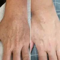 پاک کنندلکه قطعی تضمین 100%