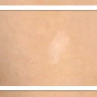 مشکلات پوستی