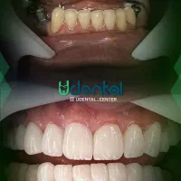 ارتودنسی کامپوزیت لمینت ایمپلنت