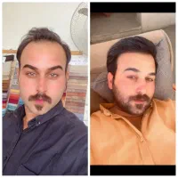 کاشت مو با کمترین قیمت