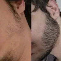 رویش ریش