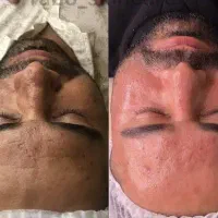 تخفیف ویژه پاکسازی پوست(لایه برداری و جوانسازی)