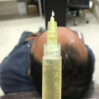 ژل ، بوتاکس ، مزو، پی ار پی