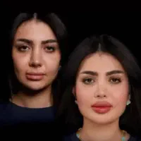 جشنواره،ژل،فیلر بادی تضمینی،مزوفیلرصورت تخصصی دقیق