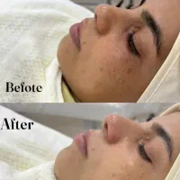 پاکسازی پوستی و حلزون تراپی