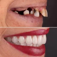خدمات ویژه و منعطف ایمپلنت
