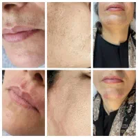 الکترولیز ،خداحافظی دائمی با موهای زائد و هورمونی