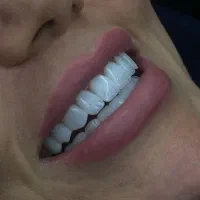 کامپوزیت دندان هرفک۷میلیون به مدت ۳روز