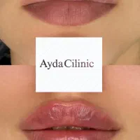 تخفیف بوتاکس و ژل یلدایی