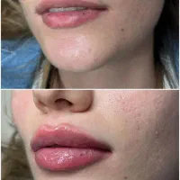 تزریق فیلر ،بوتاکس،تتو و آرایش دائم