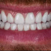 ایمپلنت شناسنامه دار کره درجه یک