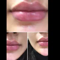 تزریق ژل و بوتاکس...اموزش