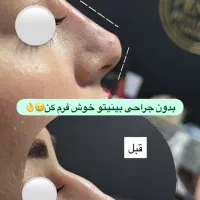 لیفت بینی NOA بدون جراحی بدون عمل و نقاهت