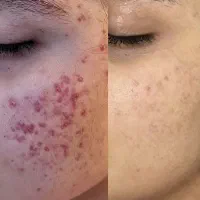 جوش جای جوش صورتتو با این کرم برطرف کن(بیوممتیک)