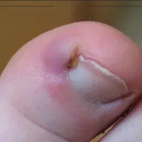 انجام گوشه پا