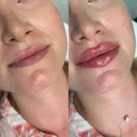خدمات ژل و بوتاکس مزو