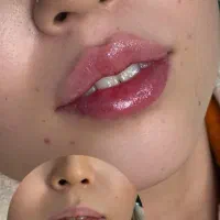 ژل لب، گونه، چانه بوتاکس و مزوتراپی