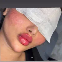 مدرک بین المللی ژل و بوتاکس