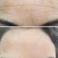 تیرگی دور چشم افتادگی پوست