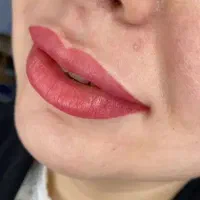 ژل لب،گونه ،بوتاکس ،خال برداری ،پی آرپی و بایوفیلر