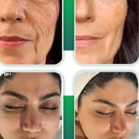 رفع لک صورت۱ تومن فیلر بادی رفع چروک جوانسازی دست