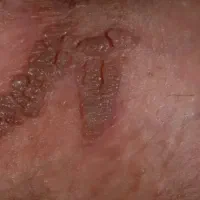حذف hpv از بدن و زگیل خطرناک