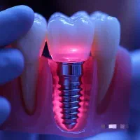 ایمپلنت یک روزه 8.800