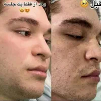 درمان تضمینی لک/کک و مک/ خال /فقط در 1جلسه