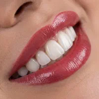 دندانپزشکی  کامپوزیت، روکش