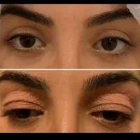 عمل رفع افتادگی پلک / رفع پف زیر چشم