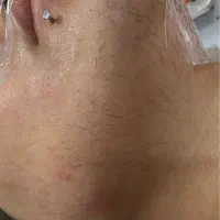 لیزر موهای صورت و ضخیم سفید و هورمونی