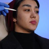 تزریق ژل و بوتاکس