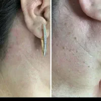 بهبود hpv