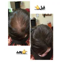 سرم تقویت وکمک به رشدمو