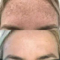 کرم جوانه گندم از بین برنده فوری جوش،جای جوش و..