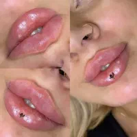 تزریق ژل فیلر بوتاکس فول فیس .مزوصورت لک چوش