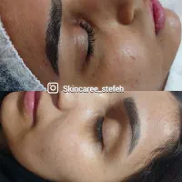 پاکسازی ، فشیال و درمان اصولی در کلینیک با تخفیف