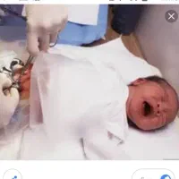 ختنه اطفال بدون درد و خونریزی