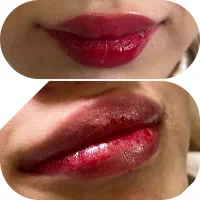 تزریق ژل و بوتاکس تخفیف