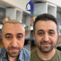 کاشت مو طبیعی با حداکثر تراکم بدون هزینه‌های پنهان