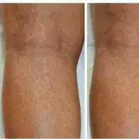 دستگاه پلکسر جوان سازی  دستگاه کامفولاژ  رفع ترک