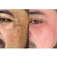 رفع تضمینی وتخصصی کک مک باتست رایگان/فقط در1جلسه