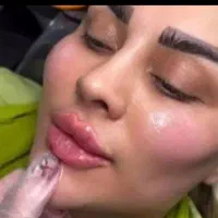 تزریق فیلر(ژل)بوتاکس برداشتن خال