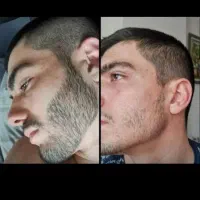 خداحافظی با کم پشتی ریش و سیبیل‌آقایان