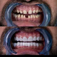 ایمپلنت ۱۵ تومن اقساطی
